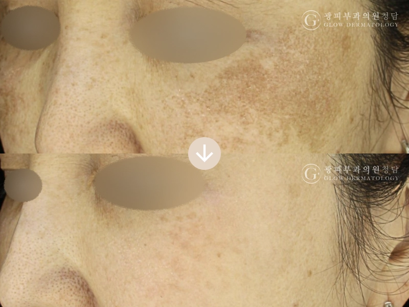 Before After